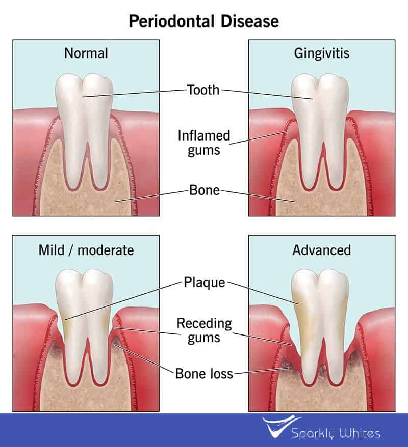 Can Gum Bleeding Really Indicate Poor Oral Hygiene Stoke?