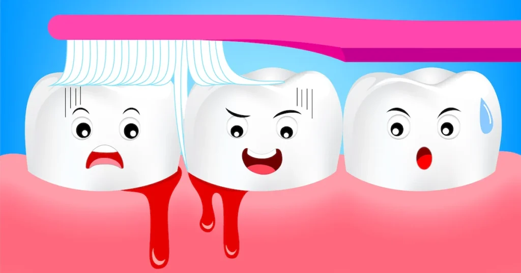 Is Bleeding Gums an Early Sign of Gum Disease Stoke?
