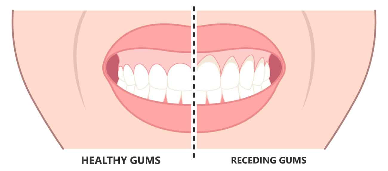What Causes Gums to Recede Over Time Stoke