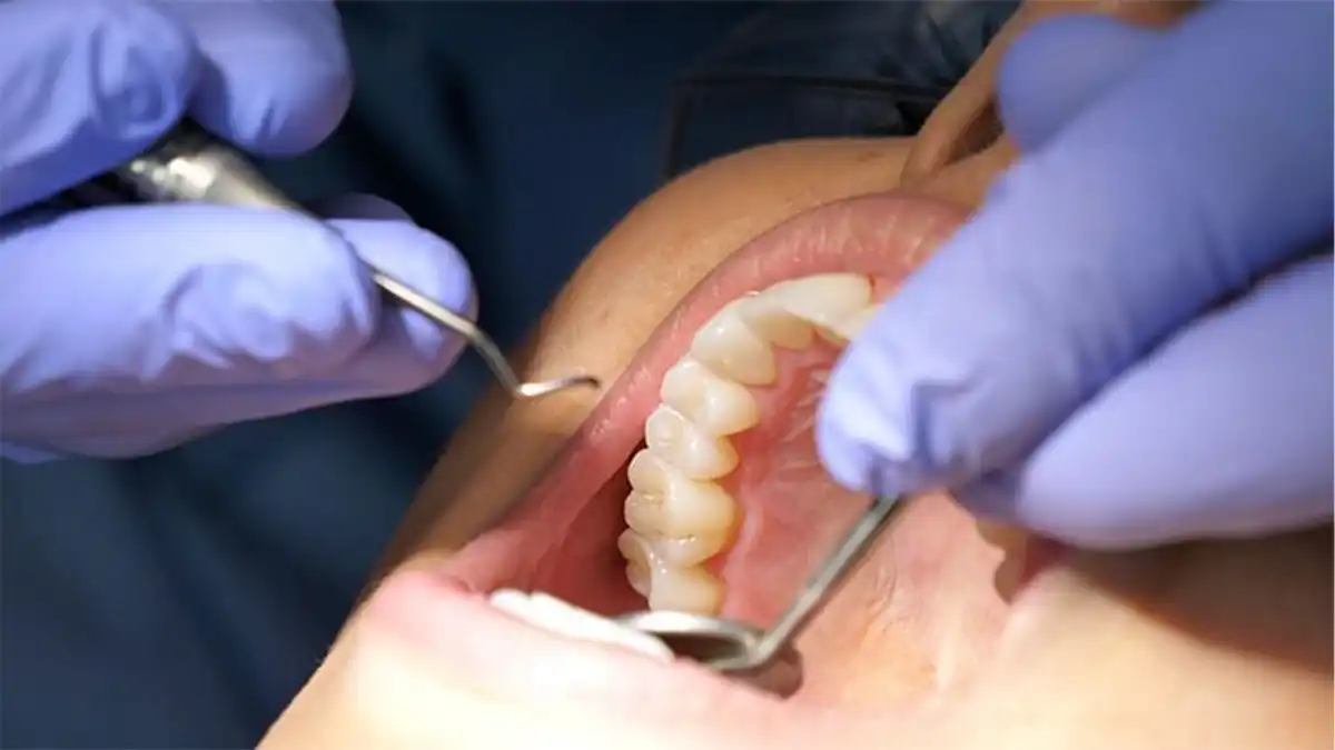 What's The Actual Difference Between Laser and Tray Teeth Whitening—And Why Should You Give a Floss Stoke?